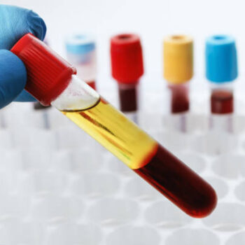 17 Alfa Hidroxiprogesterona en suero